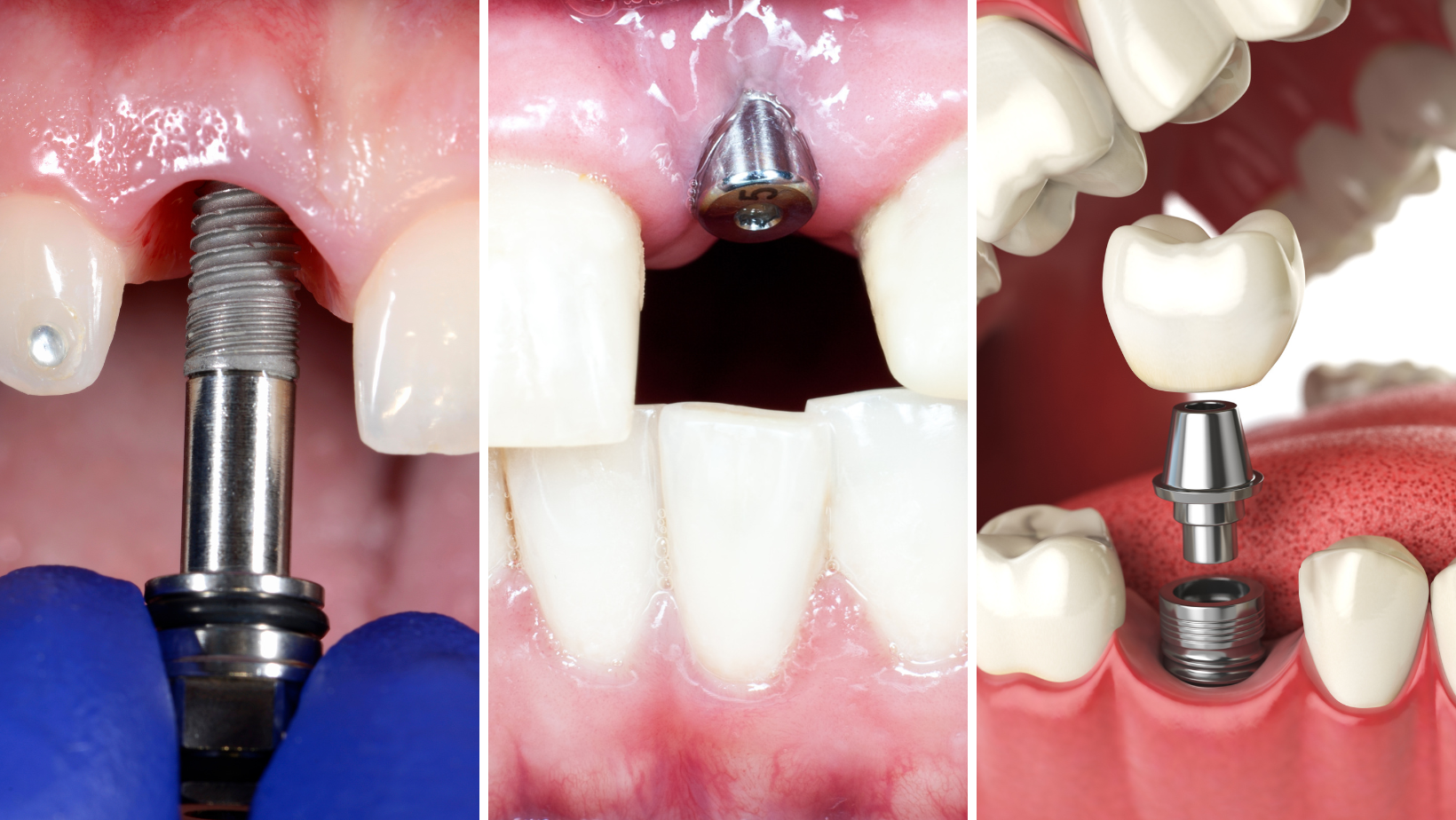 Dental implant